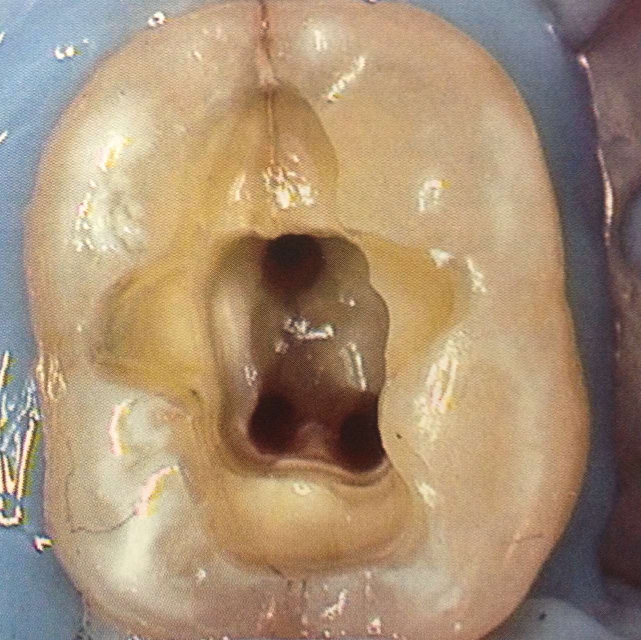 Cracked tooth 2
