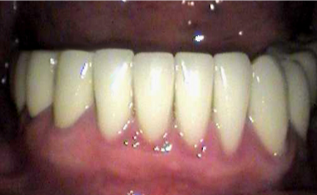 After dental implants treatment