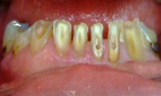 Before dental implant treatment