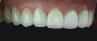 After porcelain zirconia crown treatment