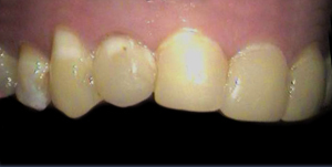 Before porcelain zirconia crown treatment